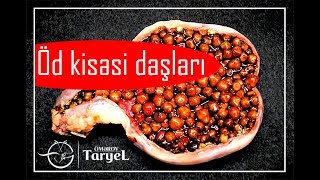 Öd kisəsi daşlarının çıxarılması