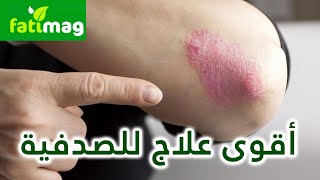 أقوى علاج طبيعي ضد الصدفية مجرب وفعال بمكونات بسيطة موجودة في كل بيت Psoriasis