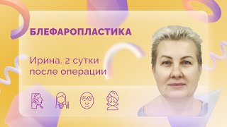 Ирина. Блефаропластика. 2 сутки после операции