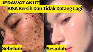 Menghilangkan Flek Hitam Dan Bekas Jerawat Bonus Wajah Glowing