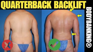 Male Body Transformation: Liposuction, Back Lift & Chest Lift (Before & After) | BodyBanking®