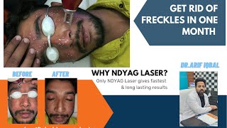 GET RID OF FRECKLES IN ONE MONTH @DrArifMDDermatologist  #frecklestreatment #pigmentation #lasertreatment