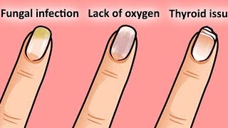 7 THINGS YOUR NAIL SAYS ABOUT YOUR HEALTH