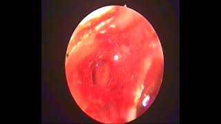 Tragal cartilage perichondrium Island graft  Tympanoplasty (endoscopic)-dr.shreekantha acharya