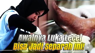 Awalnya lecet tapi bisa separah ini ❗❗ INI CARA PENANGANAN NYA ❗❗