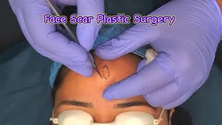 Face scar surgery @DrArifMDDermatologist #facescar #plasticsurgery #skin