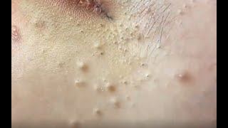 Acne clear - Blackhead removal - Beauty care video #63