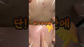 #올영세일 여드름템 이것만 기억하세요!