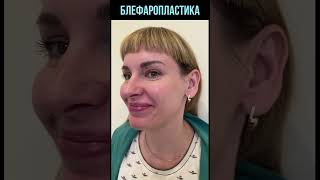 Блефаропластика ДО и ПОСЛЕ | Пластика век #shorts