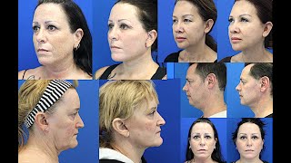 Dr. Dennis Dass Shows Facelift Results Of 4 Patients