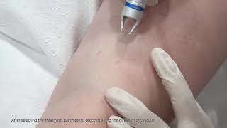 980 Vascular Removal Laser Treatment