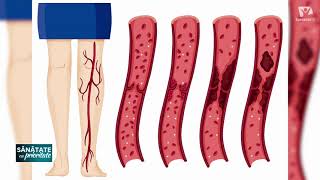 Boala arterială obstructivă | Sănătate cu prioritate | Dr Călin Popa