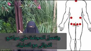 هل يمكن علاج دوالي الساقين بالحجامة                      أ سماخ الحصري