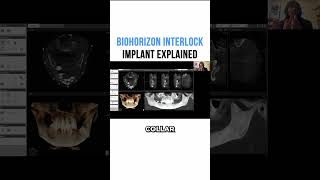 BioHorizon Interlock Implant Explained