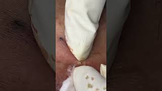 Big Cystic Acne Blackheads Extraction Blackheads & Milia, Whiteheads Removal Pimple Popping #shorts