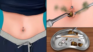 ASMR 시원함 주의! 몇 년 동안 묵은 거대한 배꼽 돌 제거하기 | 배꼽 청소 | 피어싱 제거 | Remove Huge Navel Stone