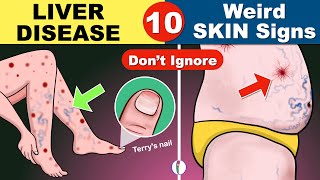 10 Skin signs of Liver Disease | Fatty liver | Cirrhosis of the Liver | Fatty liver Symptoms