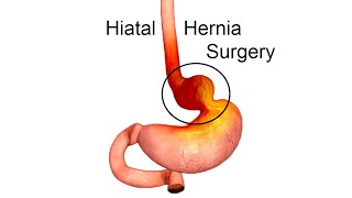 Laparoscopic Hiatal Hernia Repair with Mesh for Stomach Acid Reflux and Heartburn