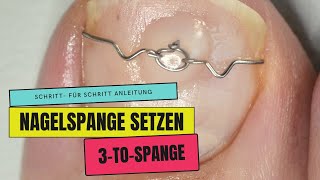 NAGELSPANGE | 3 TO Spange bei EINGEWACHSENEN NÄGELN und ROLLNÄGELN anwenden