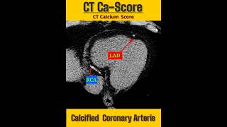 Rad Shorts/CT Calcium  Score/Calcified  Coronary  Arteries.