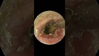 The Most Tedious Ear Fungal Removal