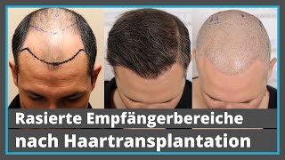 1 Jahr nach Haartransplantation: Ist eine Glatze noch möglich?