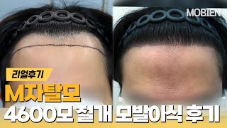 [Mobien TV] 30대 남성 M자 모발이식 절개 4600모 10개월 경과 #광주탈모치료