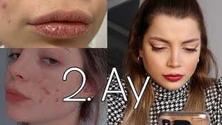 BU İLAÇ KİLO MU ALDIRIYOR? 🦵🏻 ROACCUTANE 2. AY SİVİLCE TEDAVİ SÜRECİM | BÜŞRA PEKTAŞ