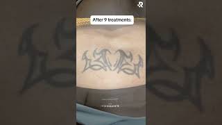 Before & After Tattoo Removal at Removery!🤩