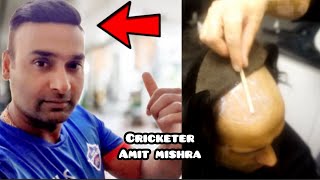 CRICKETER HAIR REPLACEMENT|Hair Transplant|Amit Mishra|patch| minoxidil|finasteride|results|hindi