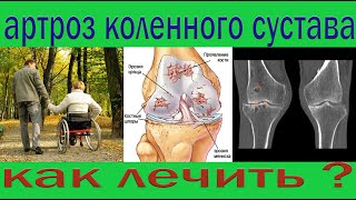 Как остановить артроз коленного сустава ???