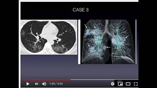 ALERT:   CT Scans May Diagnose CoronaVirus Better Than Blood Tests.