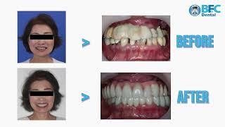 From upper failed bridge teeth/implant to All-on-6 fixed hybrid teeth (Japanese female 66yrs.)