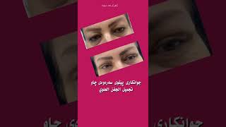 جوانکاری پێڵووی سەرەوەی چاو.#blepharoplasty