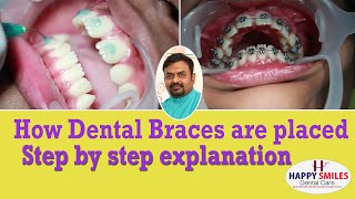 How Dental Braces Are Placed | How Braces Are Put On |Dr Chandra Shekar Alladi |Step By Step Process