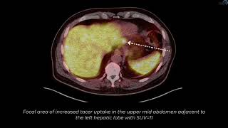 Ga-68 PET/CT Case 2