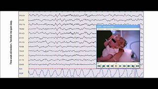 12 DRA EVELYN LORA ELECTROENCEFALOGRAFIA NEONATAL