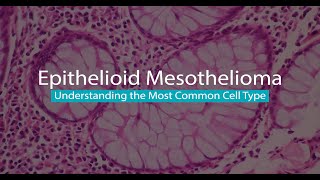 Epithelioid Mesothelioma | Mesothelioma Hope