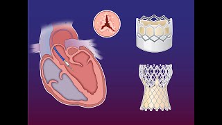 Self-Expanding vs. Balloon-Expandable TAVR with Small Aortic Annulus | NEJM