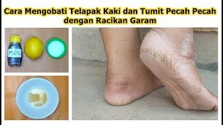 Cara Mengobati Telapak Kaki dan Tumit Pecah Pecah dengan Racikan Garam