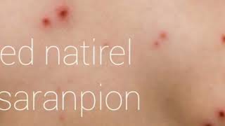 remed natirel sa bon pou sarampion