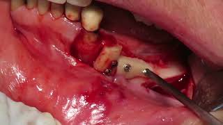 Autogenous block Graft with re-entry