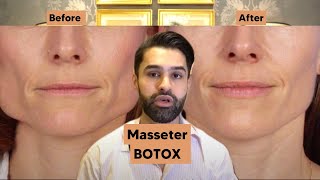 No More Grinding - Masseter Botox