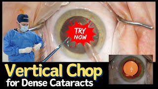 Vertical Chop | A Technique for Dense Cataracts