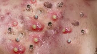 Huge Acne Relaxing