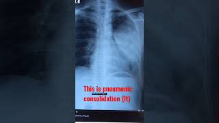 Consolidation| pneumonic consolidation| #chest #examination