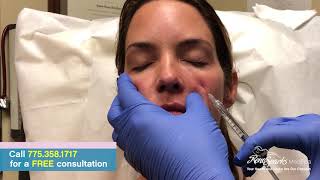 Juvederm filler for baggy eye sockets and dark circles under the eyes using a cannula