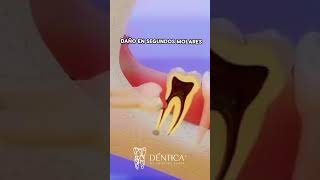 extracción de cordales  #odontologia #shortvideo