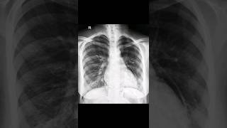 Spot Diagnosis CXR (Part 4) #cxr #medical_snippet #shorts