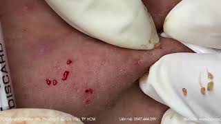 Big Cystic Acne Blackheads Extraction Blackheads & Milia, Whiteheads Removal Pimple Popping